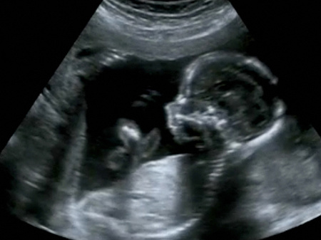 Obstetric Ultrasonography Ultrasound Echography of a fourth month fetus