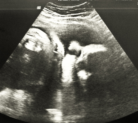 Embryo im Ultraschall / kathbild.at