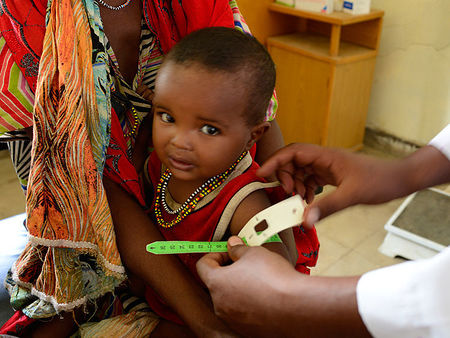 Von Unterernährung betroffenes Kind in Äthiopien