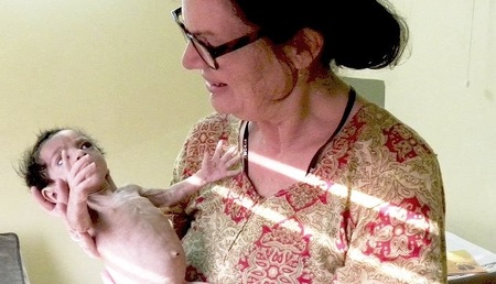 Unterernährtes Flüchtlingsbaby in Pakistan